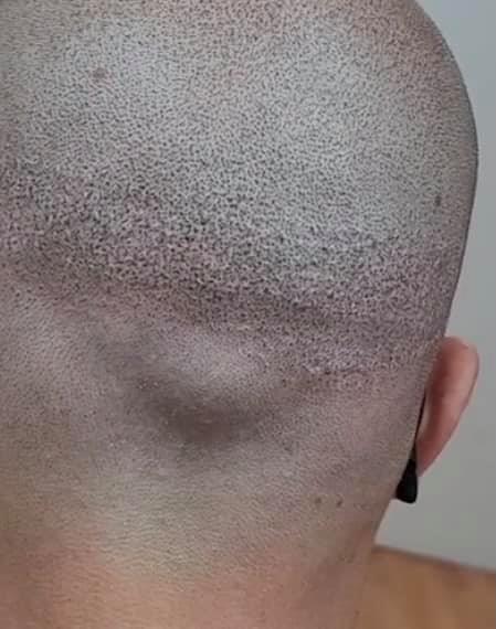 close up of the back of someones head showing scarring and the results of SMP procedure from thINK aHEAD